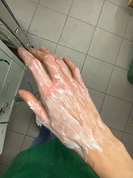 just knocked a full cup of boiling water onto my hand and it is STINGING so bad 😭 i ran it under cold water and put some cream on — what else do i do?? is it gonna blister?? someone who knows first aid please